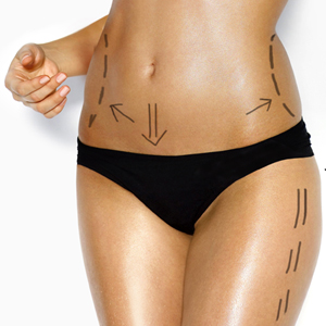Drawing on a woman's body before plastic surgery גוף אישה לפני ניתוח פלסטי