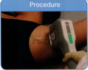 procedure-mira-drey-001-300x239 טיפול בהזעת יתר