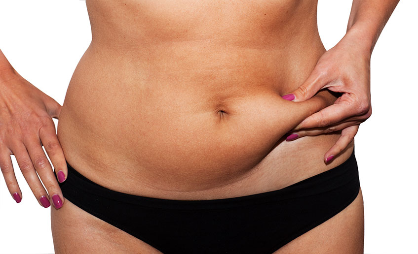 צילום חלק תחתון גוף אישה לפני ניתוח פלסטי למתיחת בטן