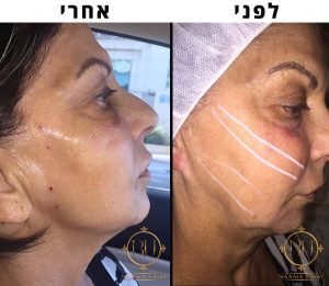 מתיחת פנים עם חוטים